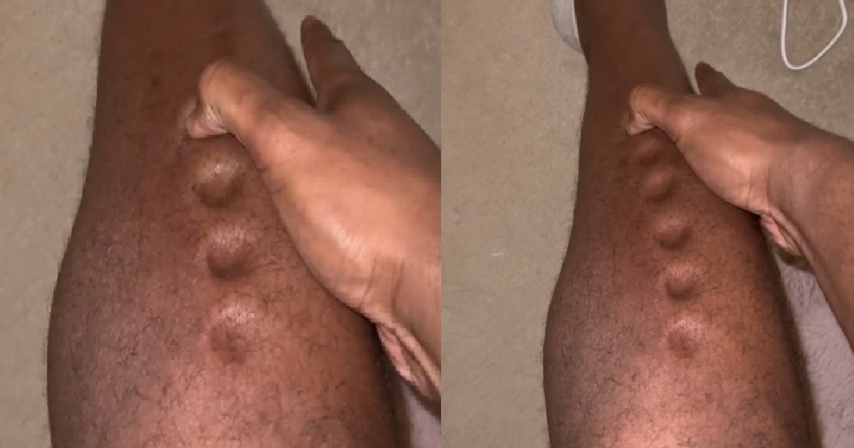 MAN SHARES HORRIFYING VIDEO OF HIS LEGS TURNING TO “PLAYDOUGH” DUE TO ILLNESS