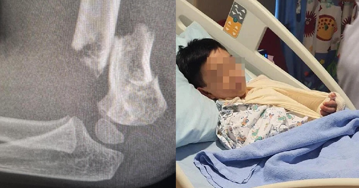 6 Y.O BOY TRIPS OVER HOLE WITH EXPOSED SCREWS @ SENGKANG PLAYGROUND, BROKE HIS ARM