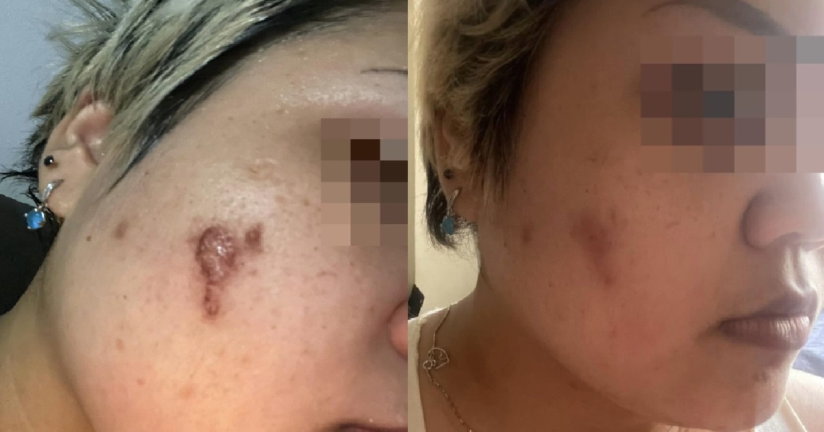 WOMAN BOUGHT FACIAL WIPES TO CLEAN HER PIMPLES, END UP WITH SCAR ON HER FACE
