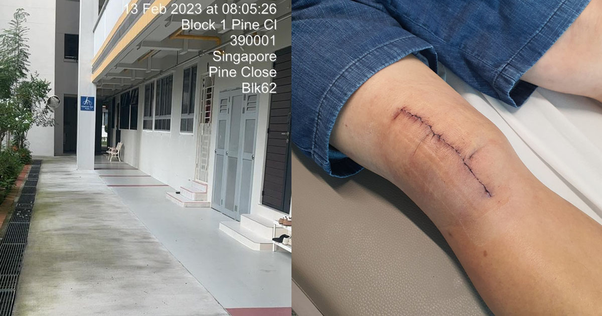 MAN FELL DUE TO SLIPPERY HDB FLOOR UNTIL NEED SURGERY TO REPAIR KNEE CAP