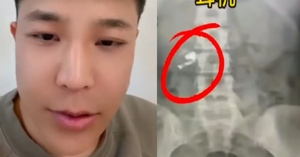 MAN FELL ASLEEP WHILE WEARING WIRELESS EARPHONES, WOKE UP WITH ONE INSIDE HIS STOMACH