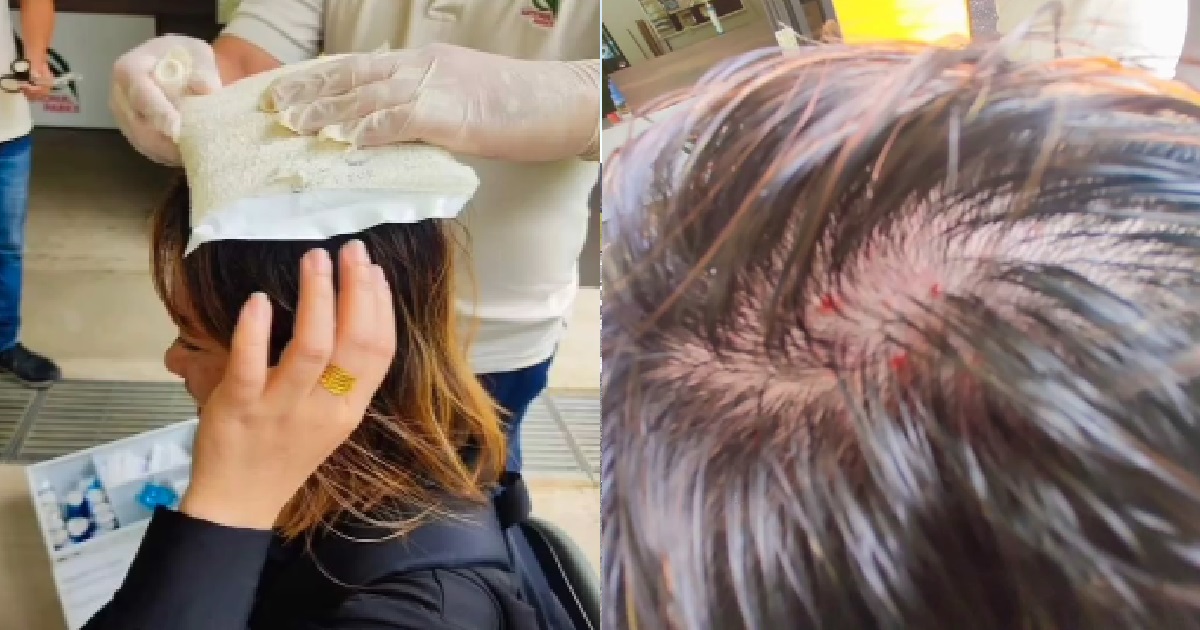 GROUP HIKING AT UBIN, WOMAN SUDDENLY KENA HIT ON THE HEAD BY FALLING DURIAN