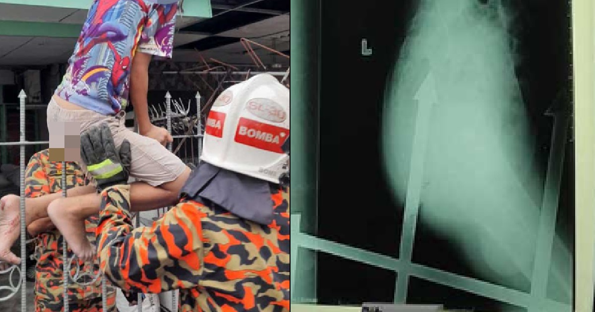 12 Y.O BOY SLIPPED ON FENCE, IMPALED BY SPIKE 15CM UP HIS BACKSIDE & STUCK FOR 20 MINS