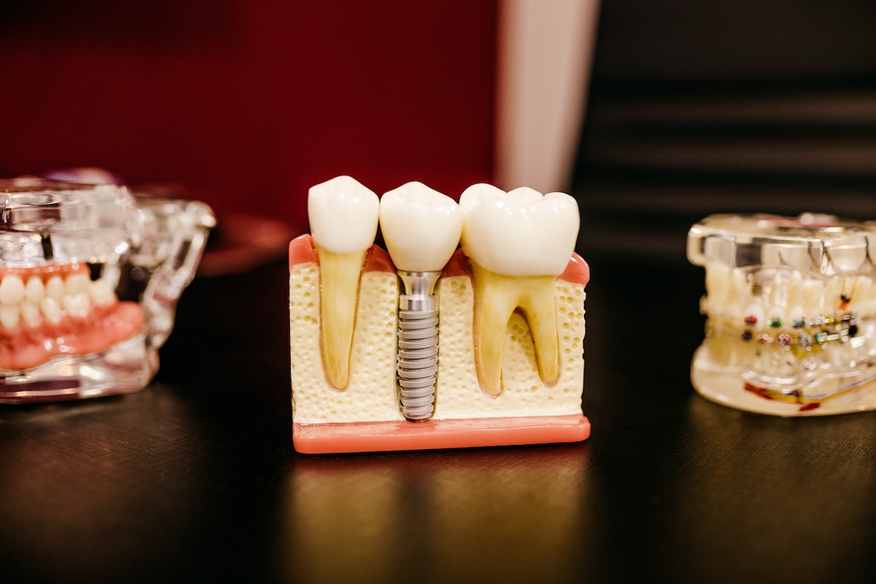 MAN RATHER GO MALAYSIA FOR DENTIST THAN IN SG, MUCH MORE CHEAPER