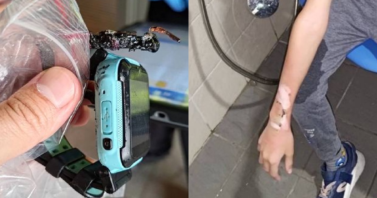 XIAO DIDI’S SMARTWATCH EXPLODES ON HIS ARM, SUFFERS 2ND-DEGREE BURNS ON BOTH ARMS