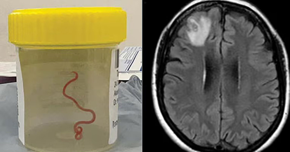 DOCTORS FOUND LIVE WORM WRIGGLING IN FEMALE PATIENT’S BRAIN IN AUSTRALIA