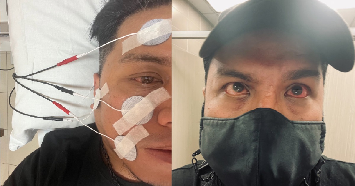 MAN WOKE UP ONE MORNING WITH HALF HIS FACE SUDDENLY PARALYSED, NOW NEED 1 HR TO EAT SOUP