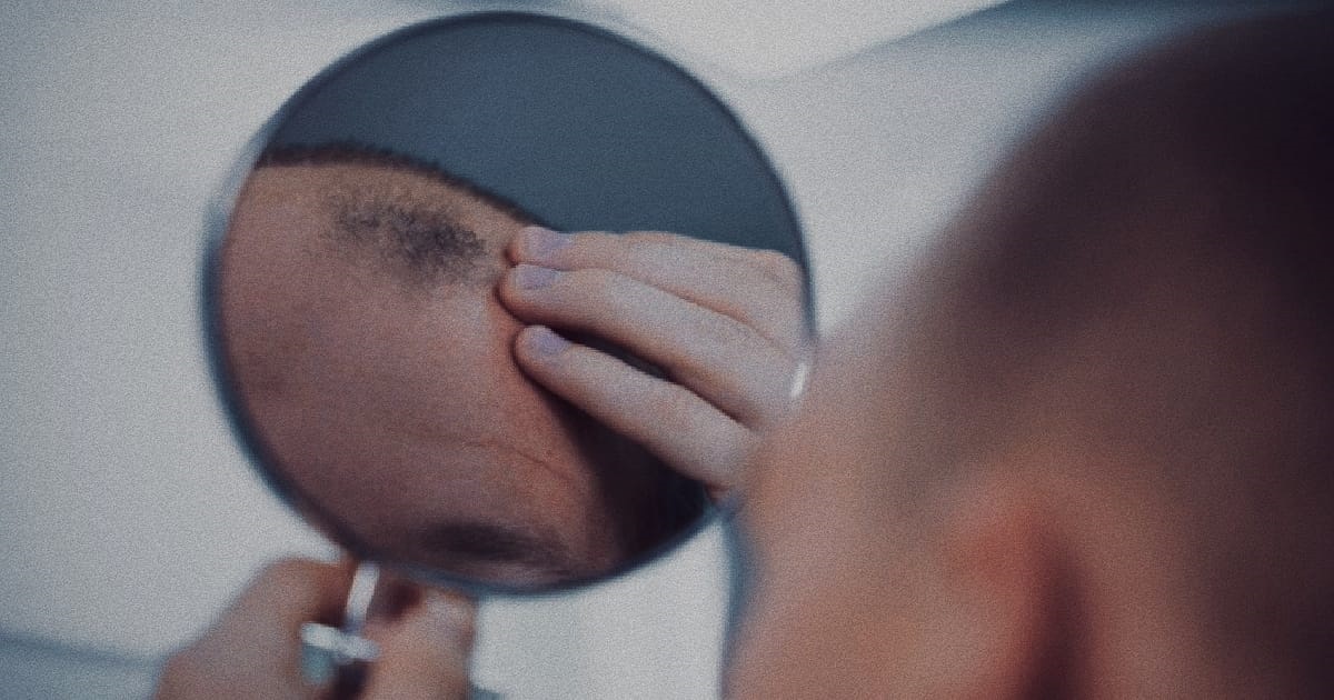 SG MAN STARTED BALDING AT 20, TRIED TO FIGHT IT BUT EVENTUALLY GAVE UP & WENT FULL “THE ROCK”