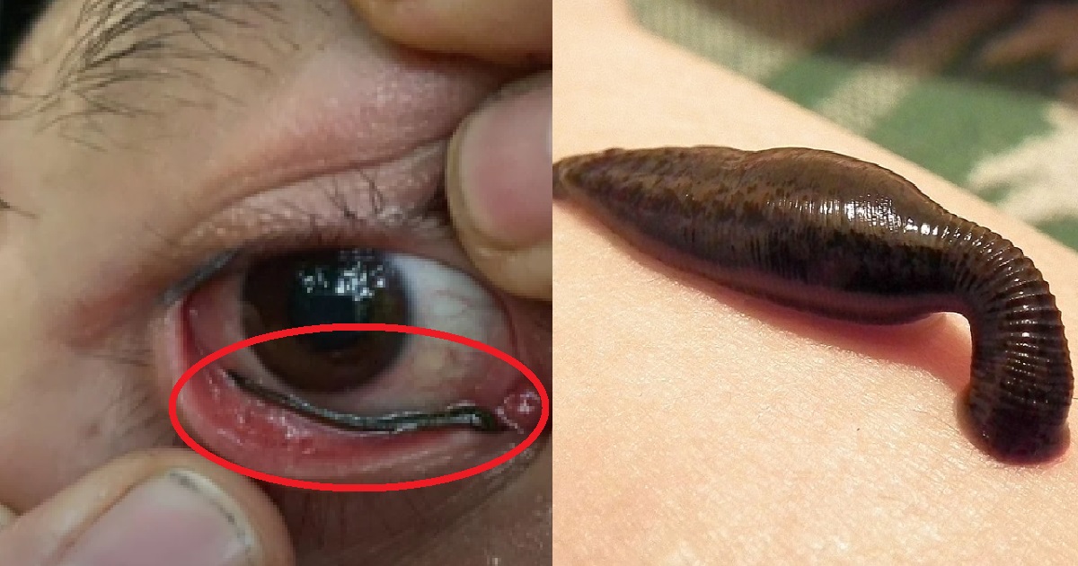 MAN HIKING HALFWAY, LEECH CRAWLS INTO HIS EYE & FEEDS ON HIS BLOOD, SCREAMS IN HORROR