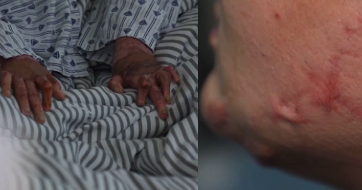 PRC Teen Suffers Permanent Hand Injury After Butane Inhalation Explosion