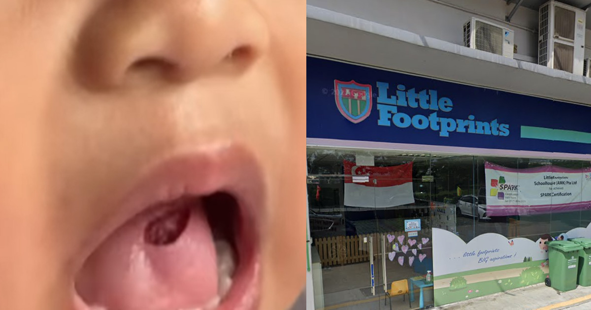 Toddler Gets 12 Stitches on Tongue After Fall at AMK Preschool, Mum Alleges Incident Was Downplayed